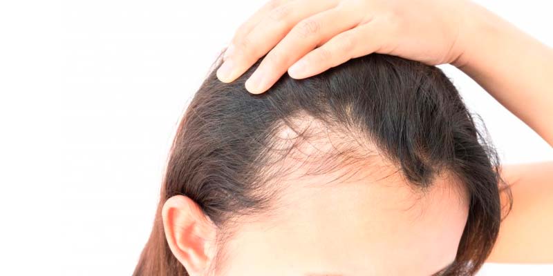 Hair Loss Causes and Risk Factors